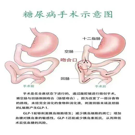 国家卫健委为何禁止这一“糖尿病手术”？